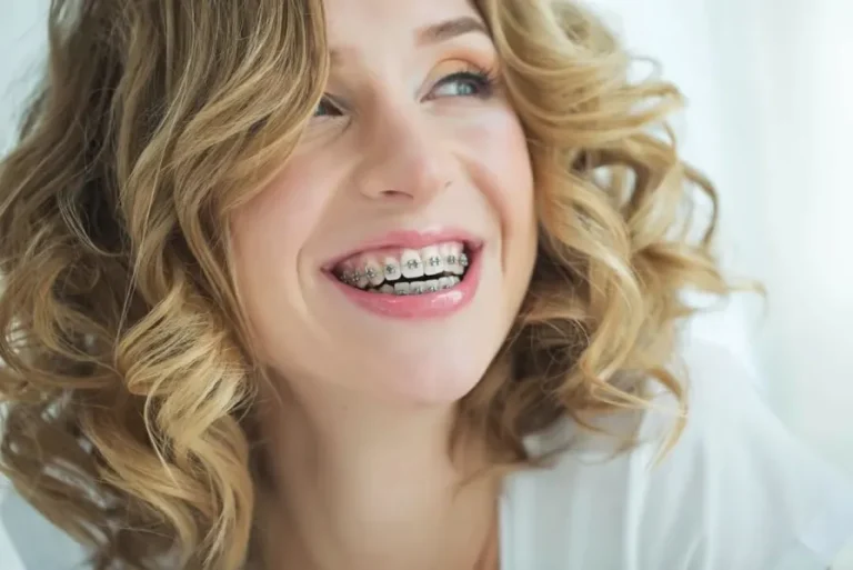 Dental Braces in London